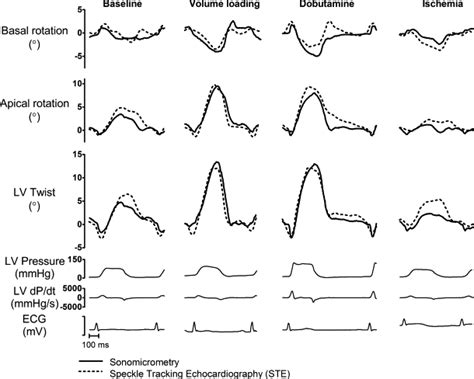 Apical Rotation By Speckle Tracking Echocardiography A Simplified