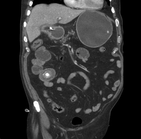 Full Text Gallstone Ileus International Journal Of Case Reports And