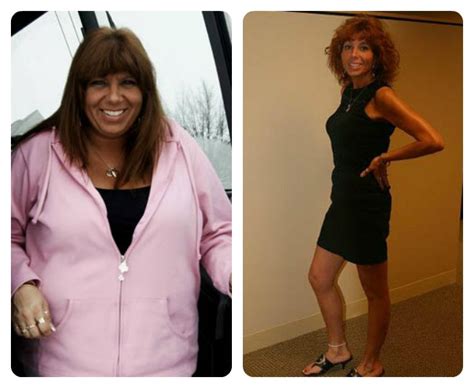 Weight Loss Surgery Before and After Photos - Health Travel Guide