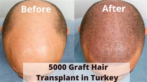 5000 Graft Hair Transplant In Turkey 5000 Grafts Hair Transplant Cost In Turkey Youtube