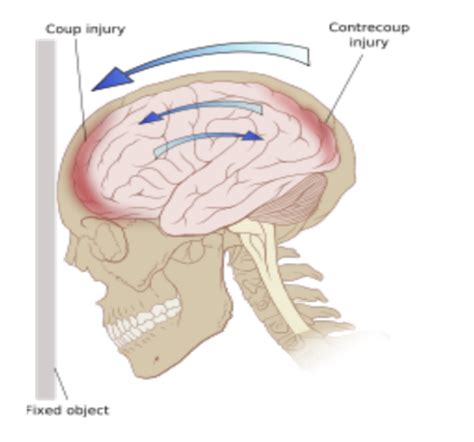 Neuropathy Traumatic Brain Injury Lecture 3 Flashcards Quizlet