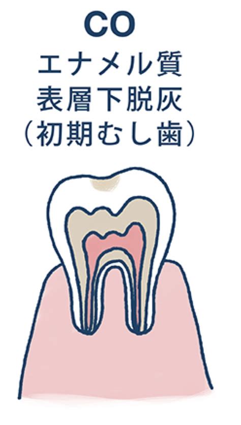 虫歯ができるメカニズム ココロ南行徳歯科クリニック