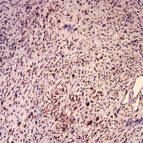 Transatrial View Of The Tumor Figure 3 Hematoxylin And Eosin Stain Download Scientific