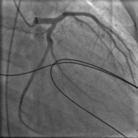 Coronary Angiography Showing Widely Patent Left Main Lad And