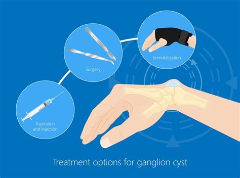 Ganglion Cyst Of The Wrist How Do I Know If I Have One