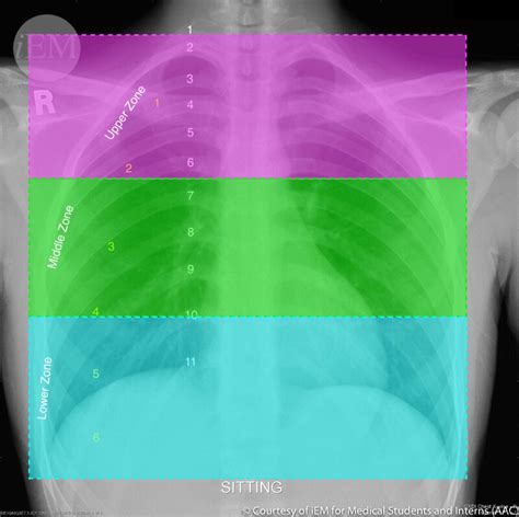 Figure Normal Pa Chest X Ray Delineated Statpearls Ncbi Bookshelf