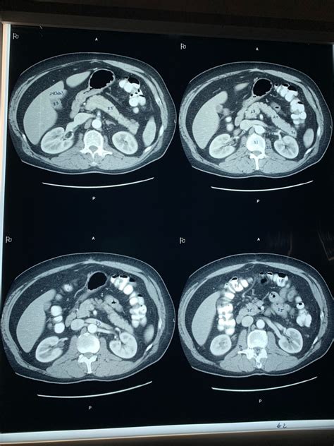 Abdomen CT (part 4) Diagram | Quizlet