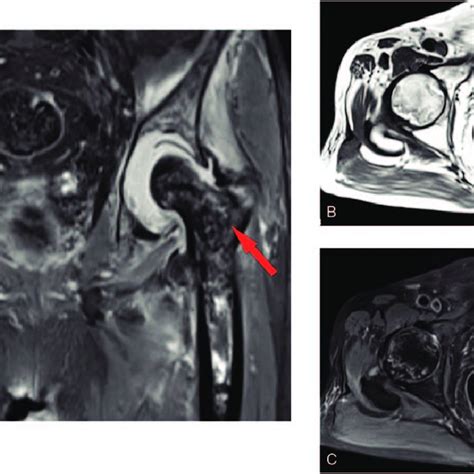 Preoperative Magnetic Resonance Imaging Of Both Hip Joints