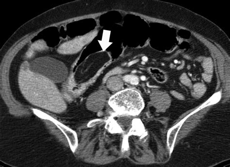 Adult Intestinal Intussusception Ct Appearances And Identification Of