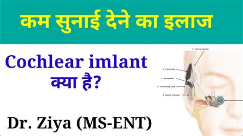 कम सुनाई देने का इलाज। Treatment Of Hearing Loss Youtube