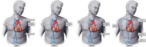 Literature Review Of Percutaneous Stenting For Palliative Treatment Of