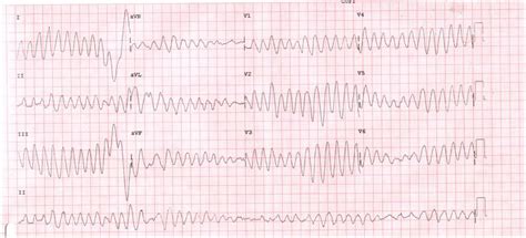 Torsades De Pointes Cardiovascular Medbullets Step 23