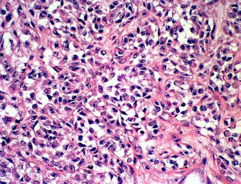 Pathology Outlines - Clear cell sarcoma