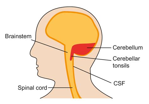 Chiari Malformation Leeds Teaching Hospitals Nhs Trust