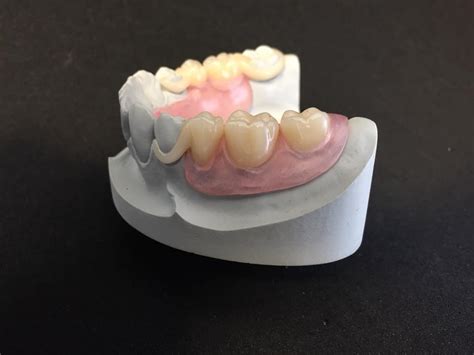 Bio Dentaplast mit Breflex 2nd... - Dentallabor Grüttner GmbH