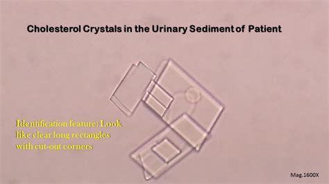 Cholesterol Crystals In Urine Introduction Clinical Significance And