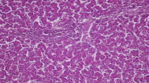 Liver Showing Dilated Sinusoids Associated With Pre Vascular