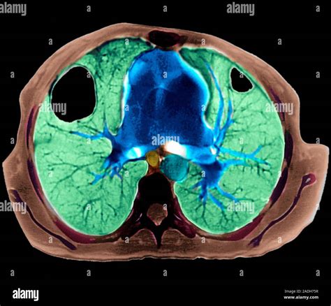 Lung Abscesses Coloured Computed Tomography Ct Scan Through A Patients Chest The Front Of