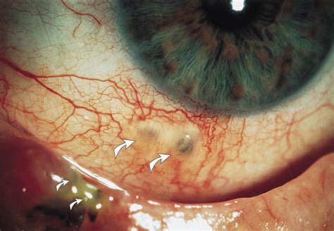 Bilateral Scleral Thermal Injury Complication After Skin Laser