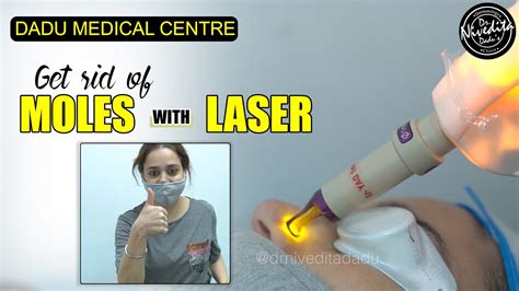 Laser Mole Removal Get Rid Of Moles With Laser Procedure Video