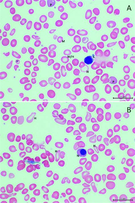 Peripheral Blood Smear X Of Case A Photomicrograph Showing