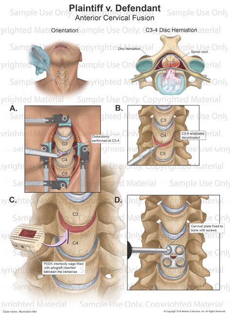 Anterior Cervical Fusion Motionlit