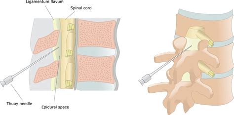 Epidurale Per Il Parto Fa Male Cosè Rischi E Vantaggi