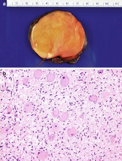 Tumors Of The Adrenal Gland Radiology Key