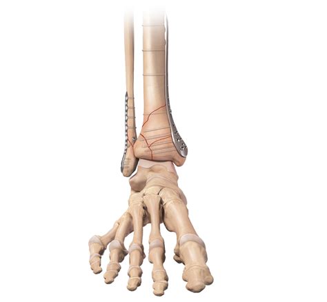 Arthrex - Distal Tibia Plating System