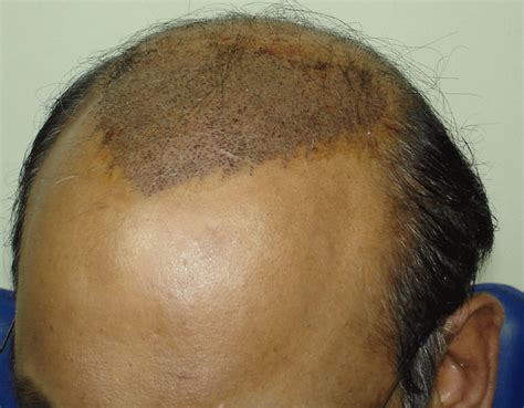 psoriasis hair loss - pictures, photos