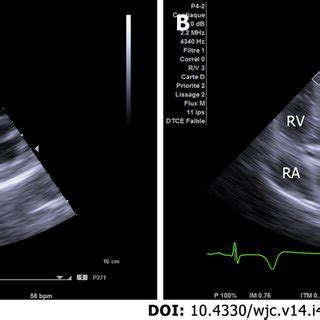 Subcostal and apical views on transthoracic echocardiogram. A ...