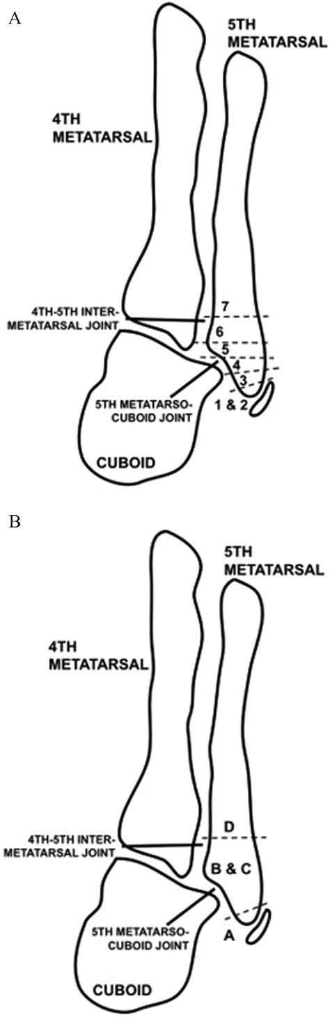 New Classification For Pediatric Proximal Fifth Metatarsal Fractures The Journal Of Foot And