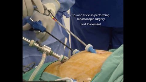 Tips And Tricks In Performing Laparoscopic Surgery Port Placement