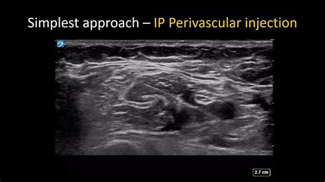 Axillary Block Ultrasound