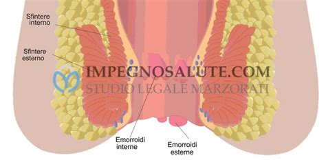 Errore Medico In Caso Di Emorroidi E Malattia Emorroidaria