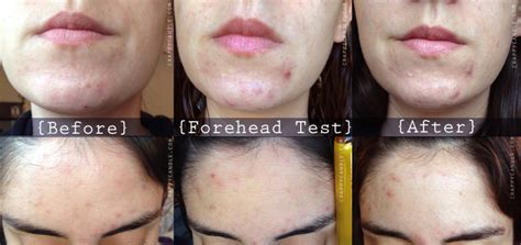 Jojoba Oil Review - The Acne Experiment | Jojoba oil acne, Acne oil ...