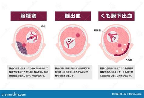 Types Of Human Brain Stroke Vector Illustration Stock Vector