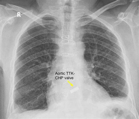 Mechanical Aortic Valve