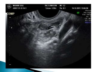 SONOSALPINGOGRAPHY STEPS BY LATE DR SAKSHI PPT