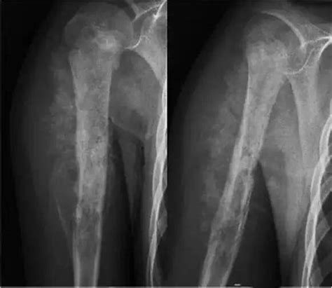 X线入门 ：几种骨肿瘤及肿瘤样病变的x线平片表现骨瘤