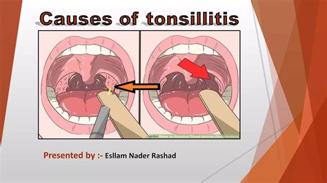 Causes And Symptoms Of Tonsillitis Ppt