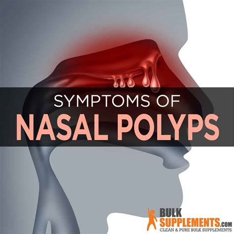 Nasal Polyps Symptoms Causes Treatment