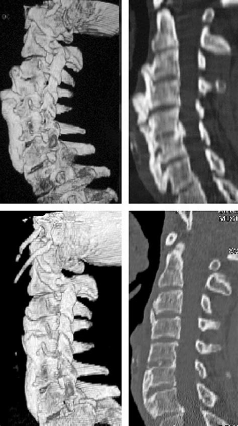 Preoperative 3D A And MPR B CT Displayed Large Bridging Osteophytes