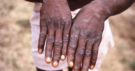 Stern New Monkeypox Sex Warning Issued As Number Of UK Cases Explode