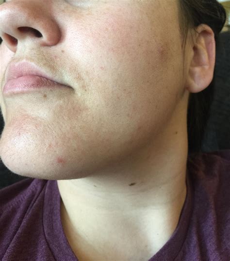 [routine Help] Uneven Skin Tone Red Spots From Hormonal Acne Dull