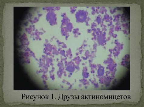 Актиномикоз. Хроническое инфекционное заболевание животных и человека ...