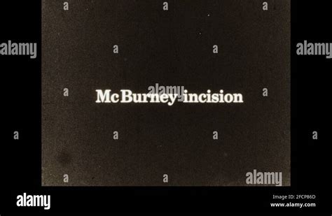 1930s: Intertitle "McBurney incision". Scalpel makes an incision ...