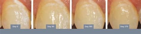 Curodont A “cure” For White Spot Lesions Orthrodontic