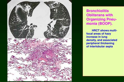 Ppt Bronchiolitis Powerpoint Presentation Free Download Id3529029