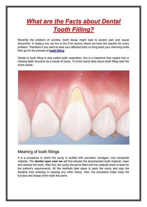 What Are The Facts About Dental Tooth Filling By Emergency Dentistinhouston Issuu